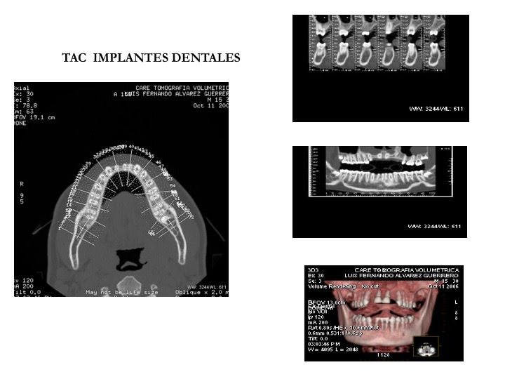 Tomografías de implantes dentales