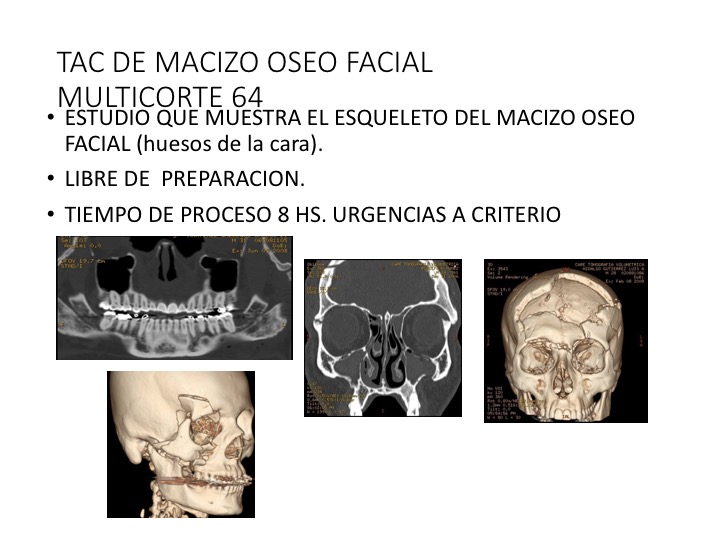 Tomografía de macizo oseo facial