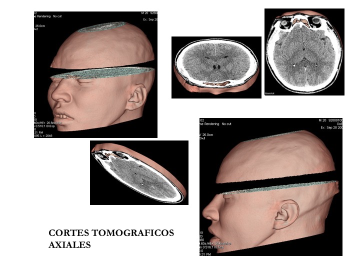Cortes Tomográficos Axiales