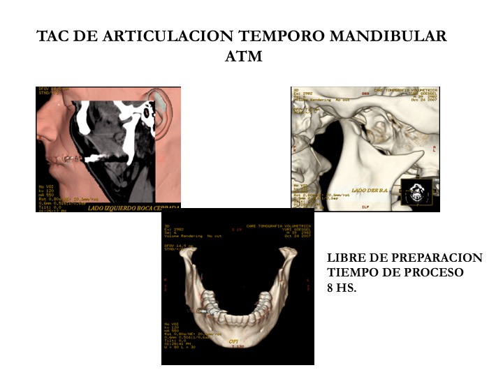 Tomografía mandibular