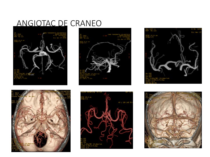 Angiotac de craneo