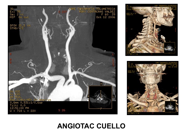 Angiotac de cuello