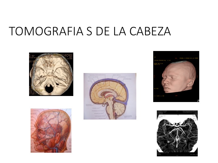 Tomografías de la cabeza