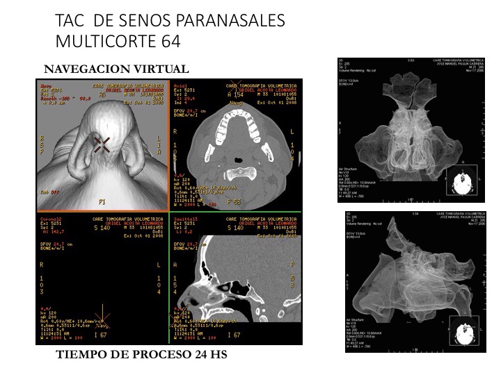 Tac de senos paranasales