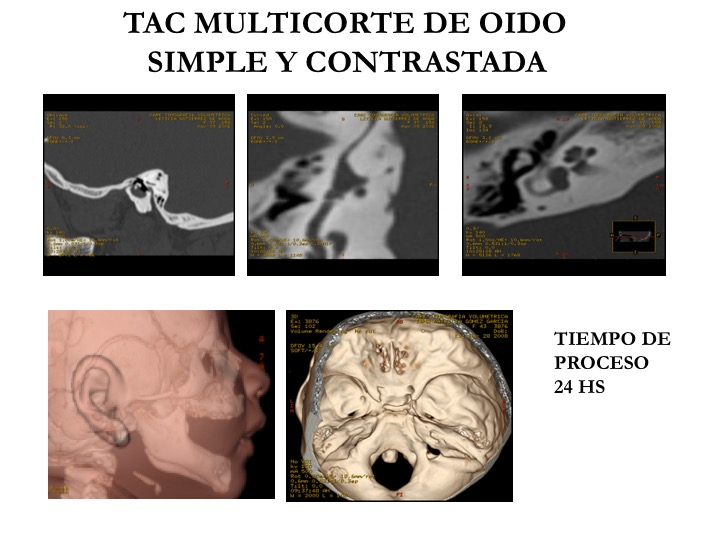 Tomografías de oido